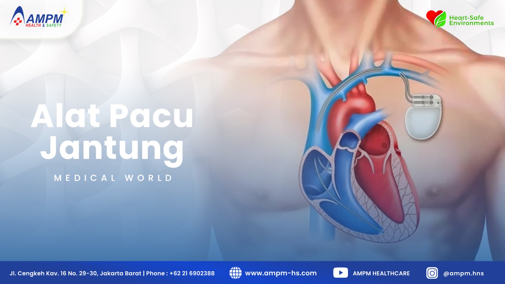 Alat Pacu Jantung (ICD)