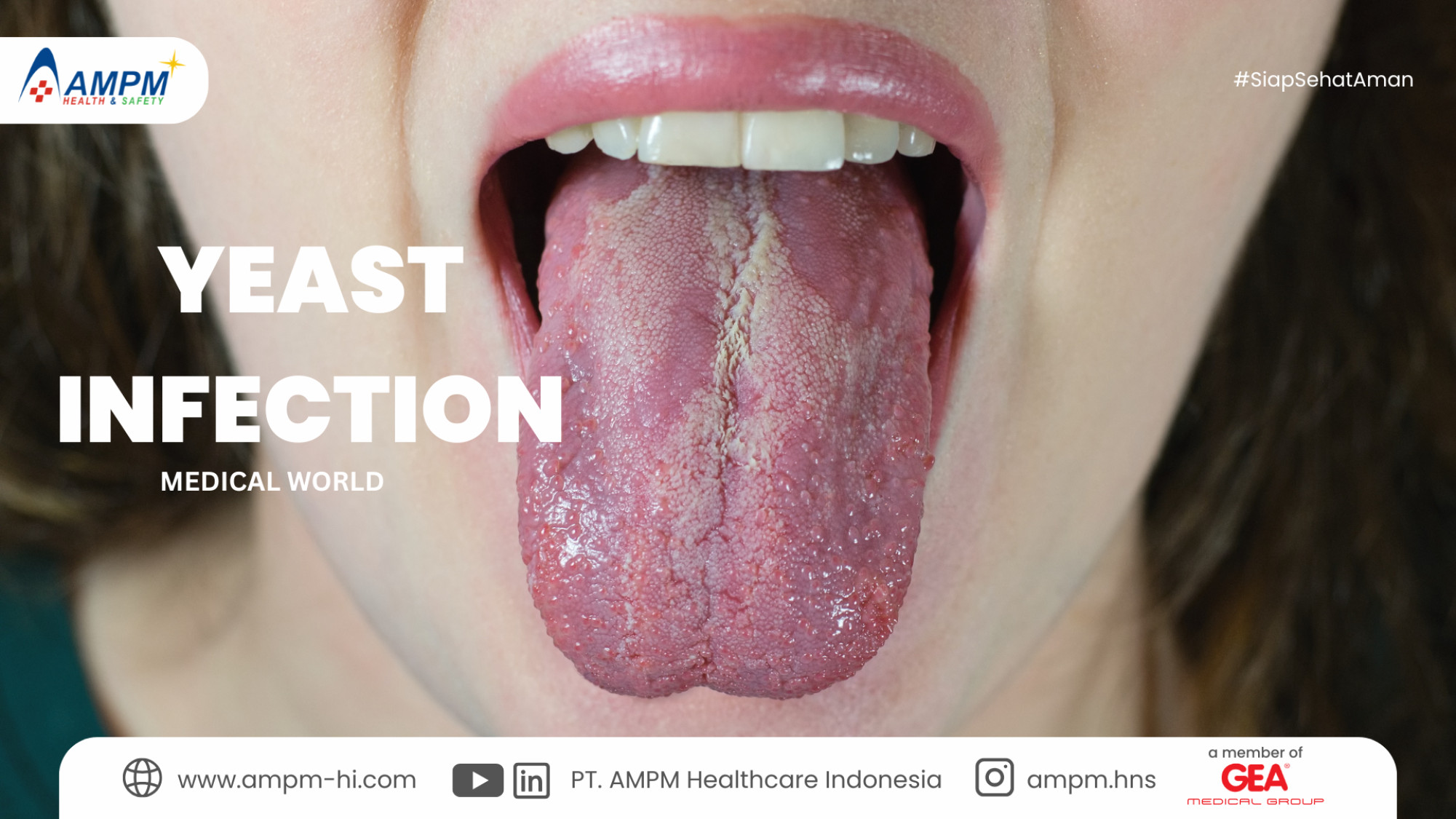 Yeast Infection (Infeksi Jamur)