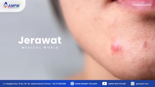 Jerawat