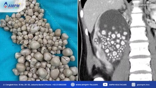 300 Batu Ginjal, Akibat Tidak Pernah Minum Air Mineral