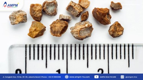 Gejala Batu Ginjal Yang Harus di Waspadai